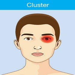 Cluster Headaches