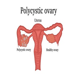 Polycystic ovary syndrome